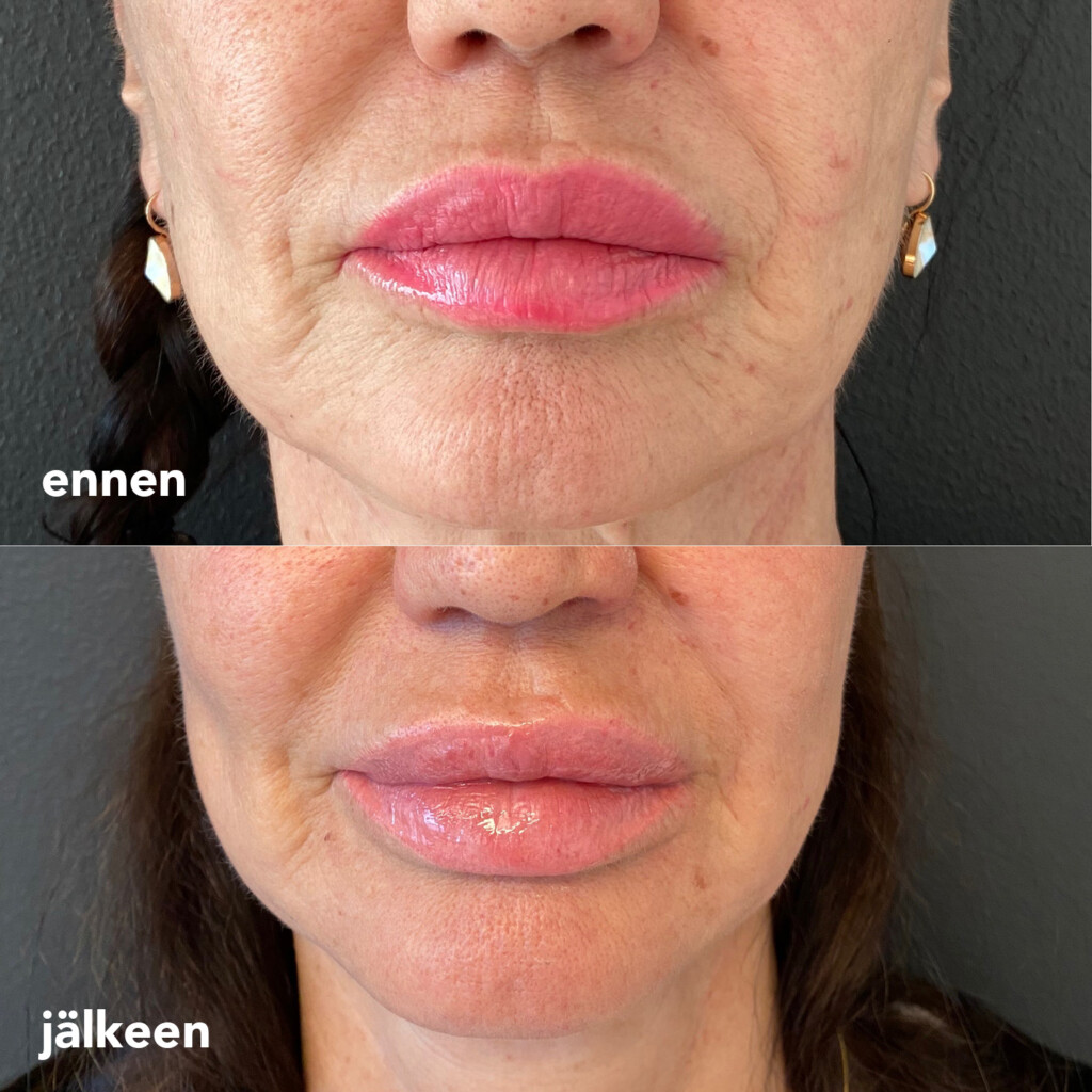 Naisen kasvot ja suunympärystä edestä kuvattuna ennen laserilla tehtyä ihon kuorintaa ja sen jälkeen.