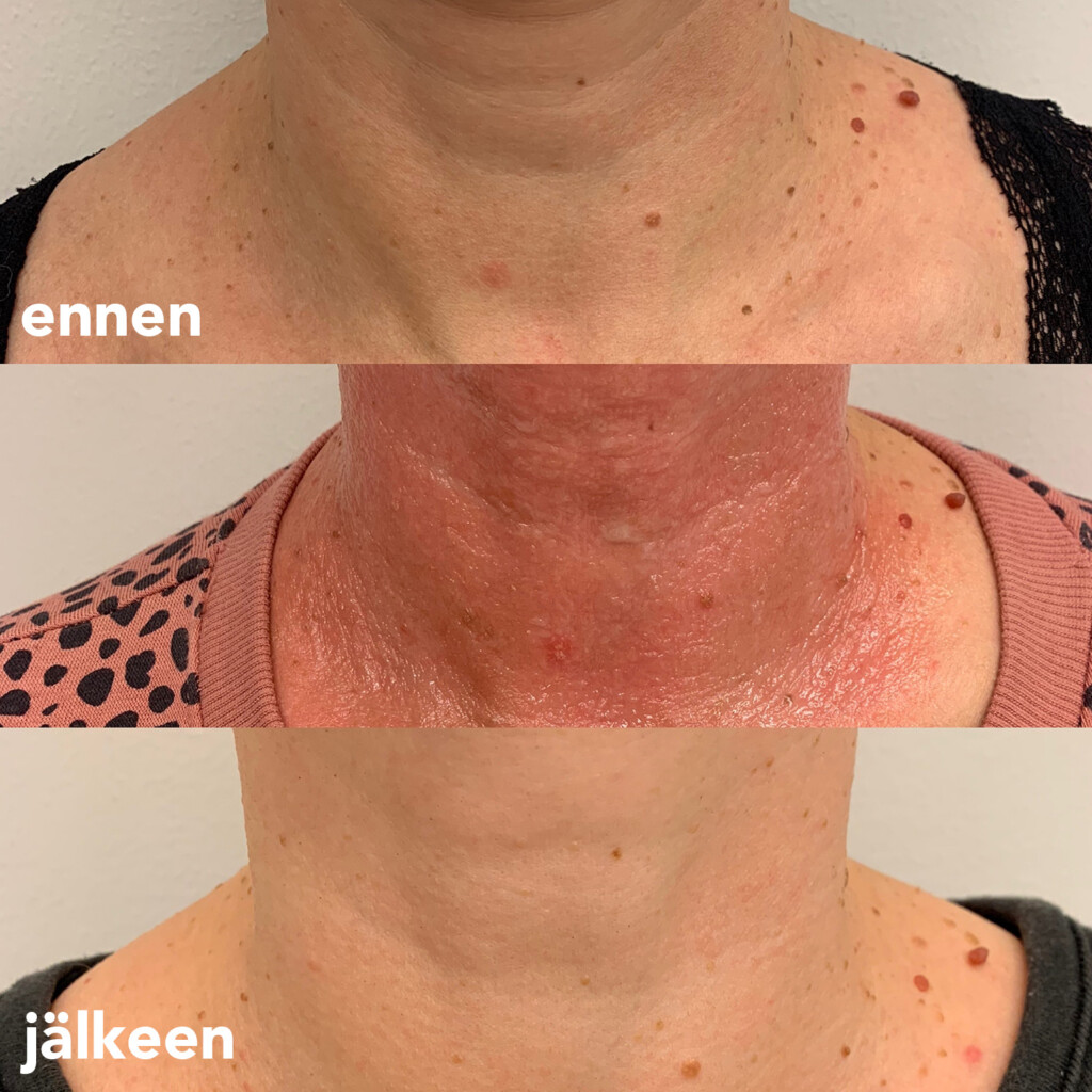 Ennen ja jälkeen -kuva naisen kaulalle laserilla tehdystä ihon nuorennuksesta.