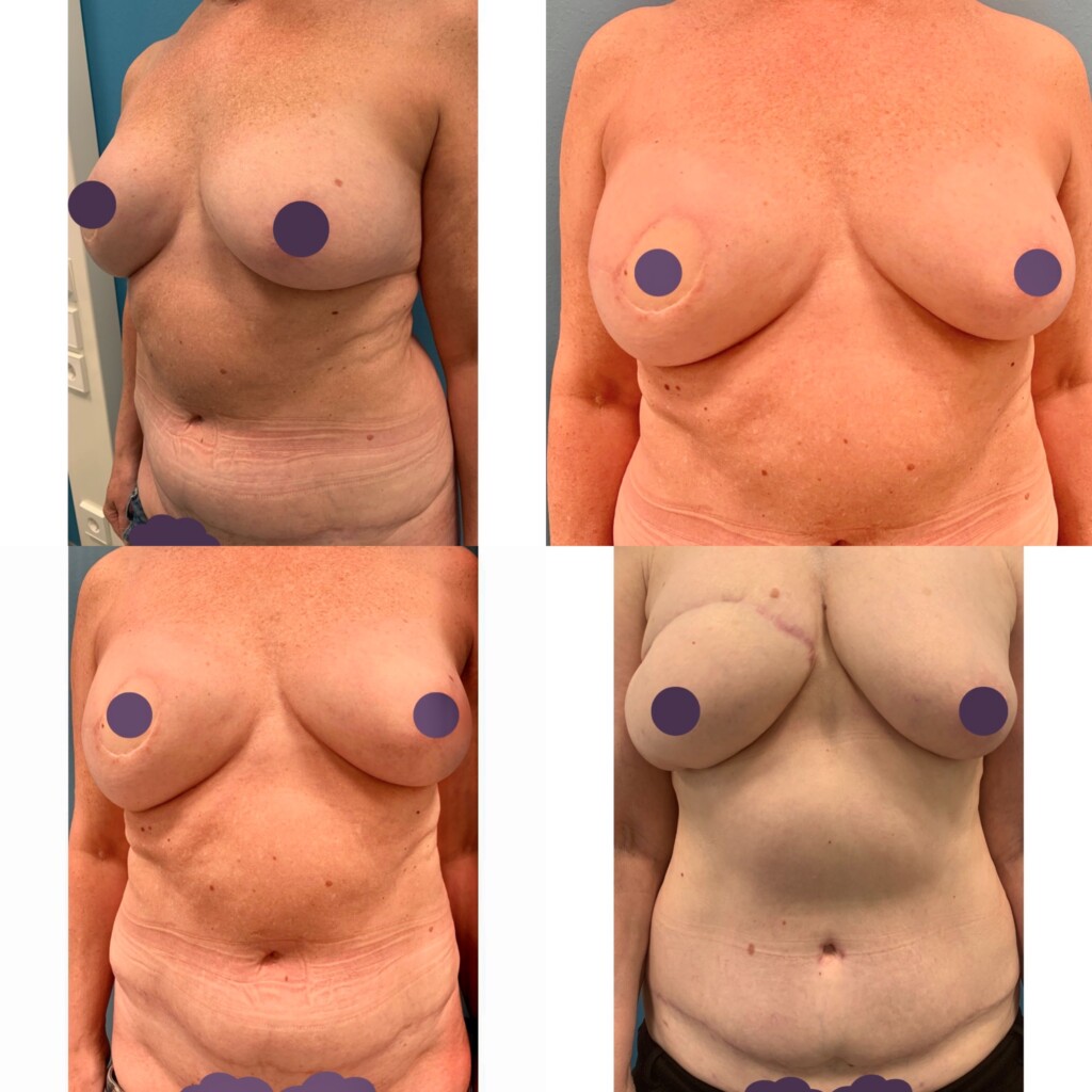 Naisen rinnat edestäpäin kuvattuna ennen syövän jälkeen tehtyä rinnan korjausleikkausta ja toimenpiteen jälkeen.
