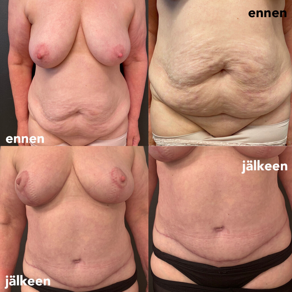 Naisen rinnat ja vatsanseutu edestä kuvattuna ennen rintojen pienennysleikkaust aja abdominoplastiaa ja sen jälkeen.