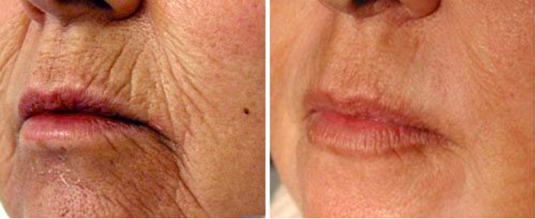 Varttuneen naisen suunympärystän juonteet ennen laserilla tehtyä ihon kuorintaa ja sen jälkeen.