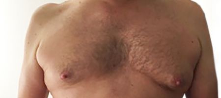 Ennen ja jälkeen -kuva miehen rinnasta jossa toisen puolen iho on hoidettu kylmähoidolla tasaisemmaksi.