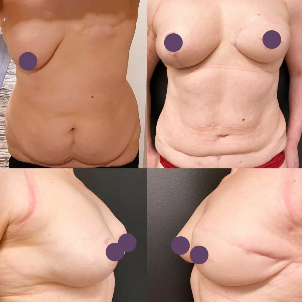Naisen rinnat edestä ja sivulta kuvattuna ennen rinnan korjausleikkausta ja sen jälkeen.