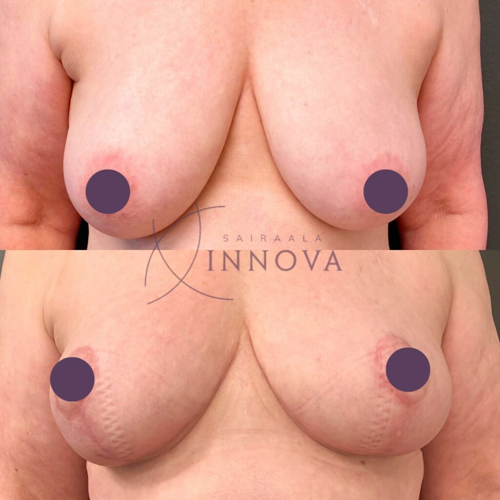 Naisen rinnat edestä kuvattuna ennen rintojen kohotusleikkausta ja sen jälkeen.