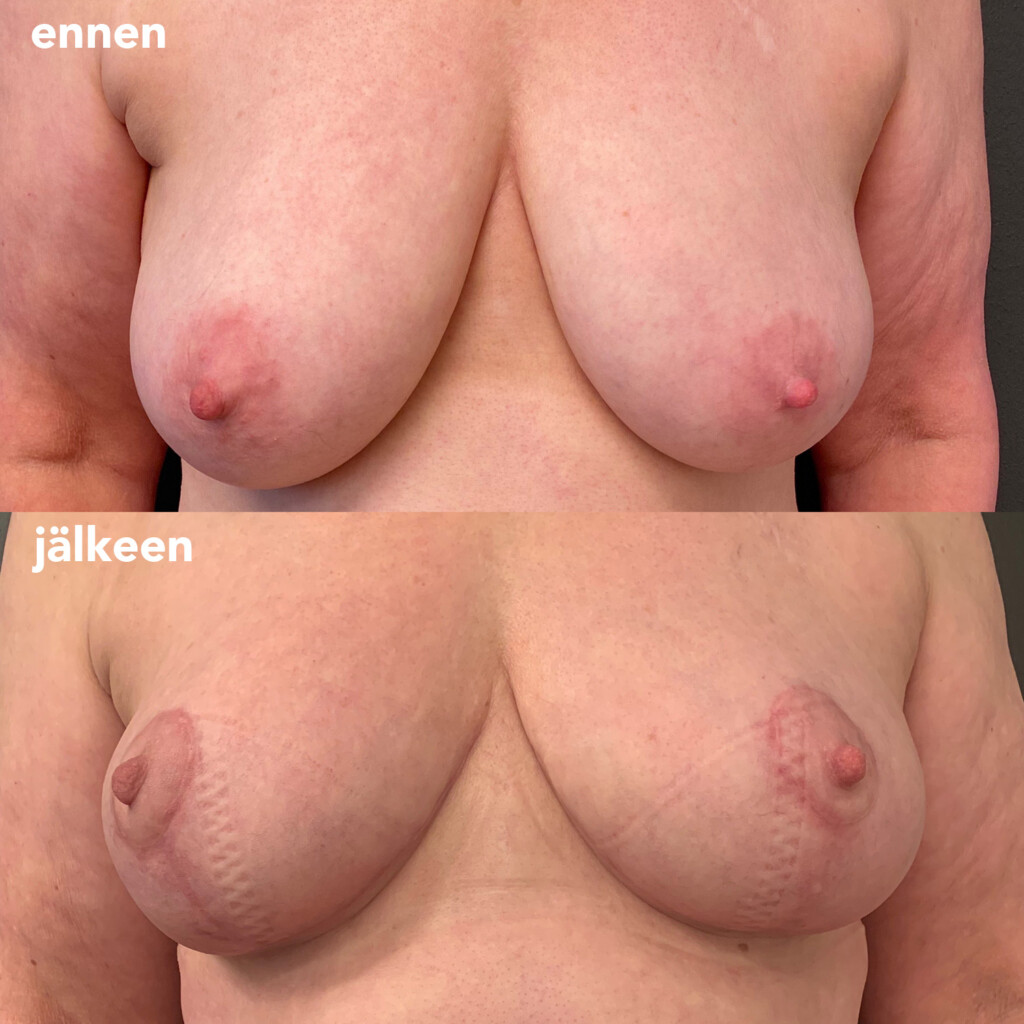 Naisen rinnat edestä kuvattuna ennen rintojen pienennysleikkausta ja sen jälkeen.