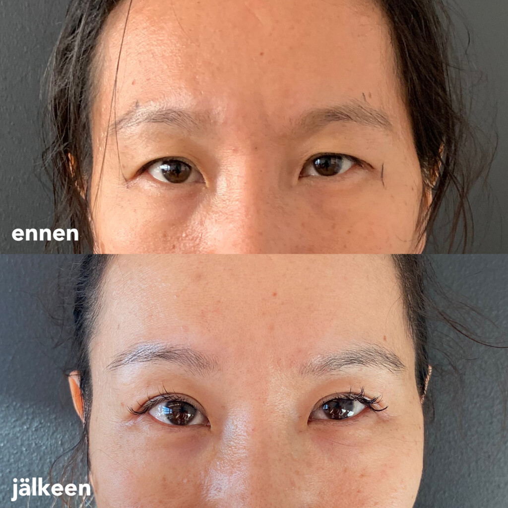 Naisen kasvot ja silmät ennen yläluomileikkausta ja sen jälkeen.