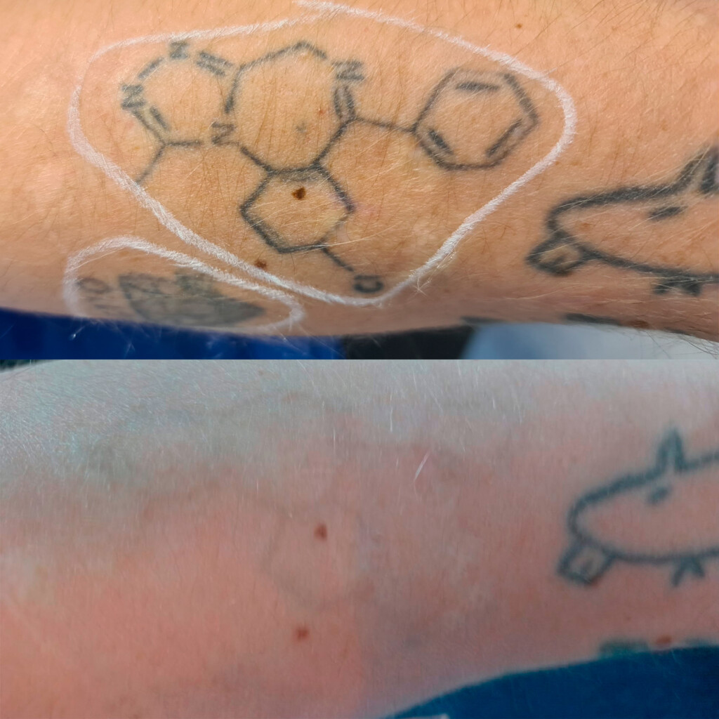 Asiakkaan käsivarresta on poistettu tatuointi kolmella laserhoitokerralla.