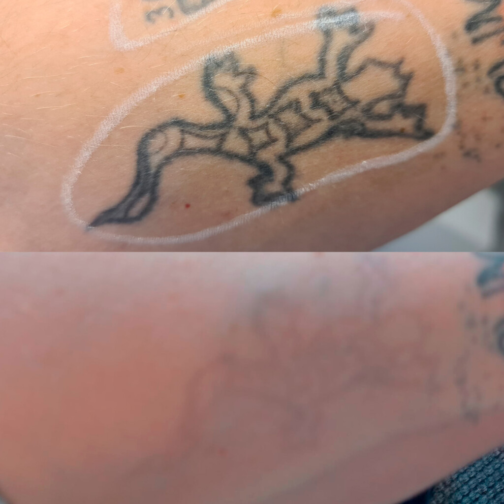 Asiakkaan käsivarresta on poistettu tatuointi kolmella laserhoitokerralla.