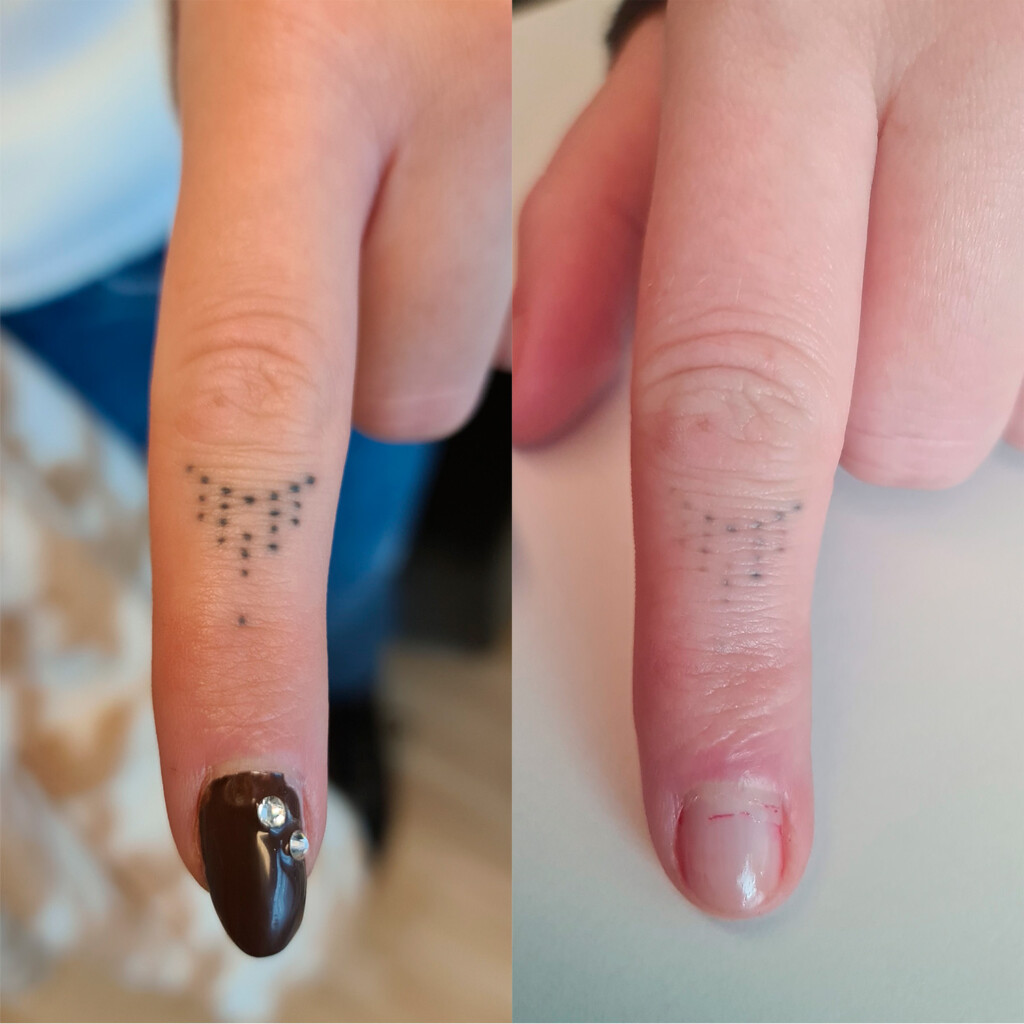 Asiakkaan sormesta on poistettu tatuointeja kolmella laserhoitokerralla.